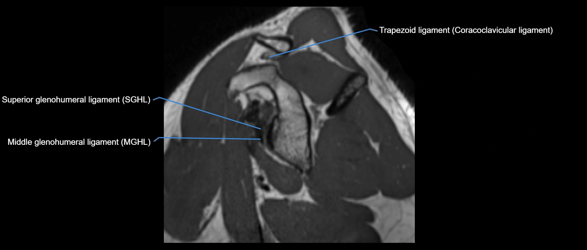 shoulder ligaments sagittal  cross sectional anatomy 3T MRI AI enhanced radiology image -img-00001-00021.webp